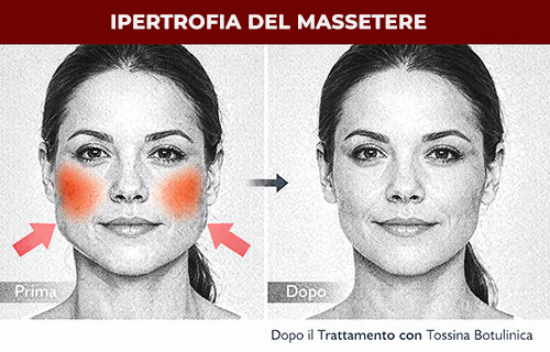 Confronto prima e dopo del trattamento dell'ipertrofia del massetere con tossina botulinica a Bologna presso la clinica Marenco.