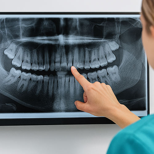 Dental specialist pointing at a panoramic digital X-ray for oral surgery planning at Marenco Dental Clinic